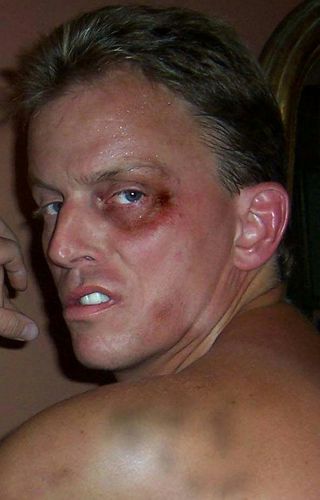 black eye bruised face boxing fighting gay man